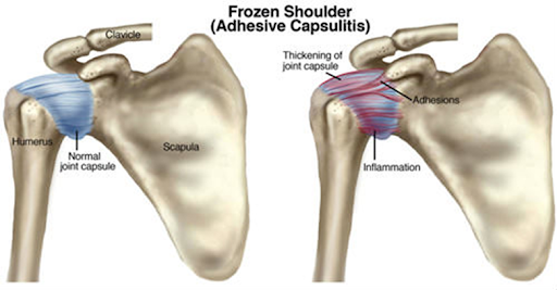 Capsulitis adhesiva ¿Cómo combatirla?