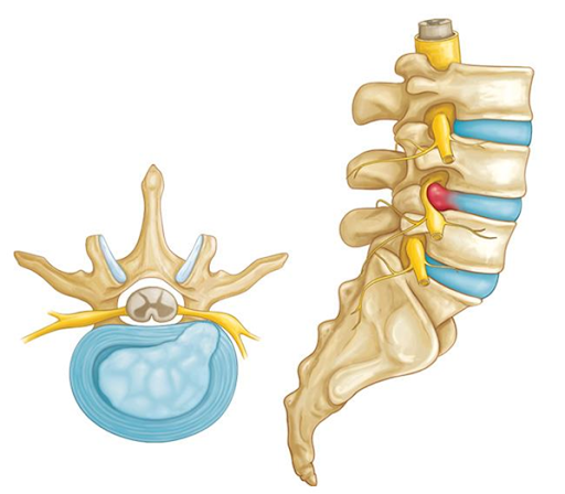 ¿Qué es una hernia discal lumbar? Diagnóstico y Tratamiento