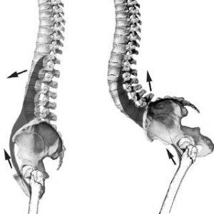 Hiperlordosis Lumbar y Dolor de Espalda - Ortoprono