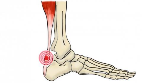 Abordaje desde la fisioterapia para la tendinitis aquilea