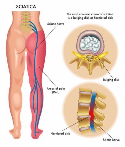 Protocolo de tratamiento para la ciática mediante la fisioterapia