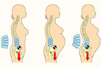 Tratamiento fisioterapéutico para corregir la hiperlordosis lumbar